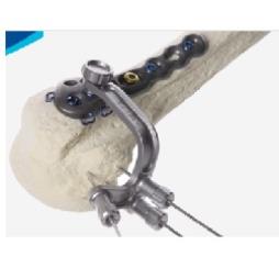 Proximal Humerus Fixation plate system