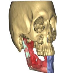 Cranio-maxillofacial Surgical Solutions